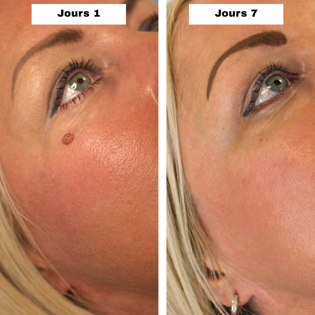DERMALYA™ | Retrouvez une peau lisse en 4 jours