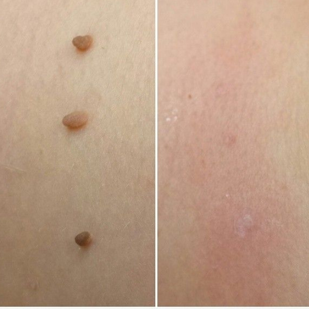 DERMALYA™ | Retrouvez une peau lisse en 4 jours